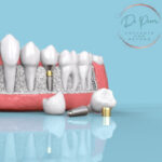 Logotipo del grupo Counting the Cost of Dental Implants: Value for a Lifetime (Doctor Prem)